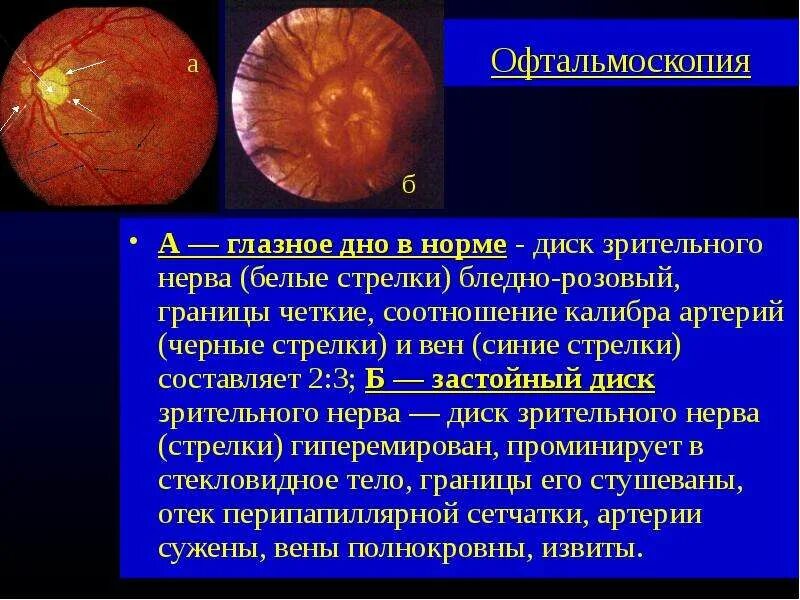 Норма зрительного нерва. Офтальмоскопия диска зрительного нерва. Диск зрительного нерва на офтальмоскопе. Диск зрительного нерва в норме описание. ДЗН сосуды офтальмоскопия.