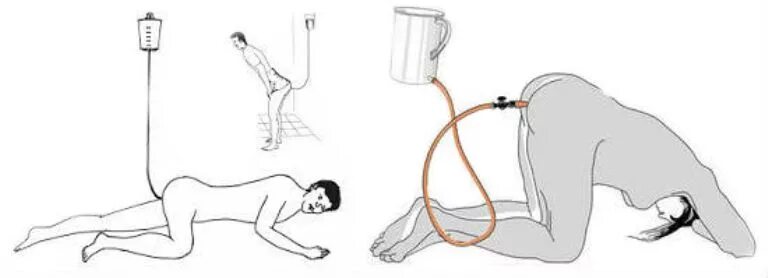 Сколько ставить клизму. Промывание кишечника Кружка Эсмарха. Промывание кишечника гидроколонотерапия схема. Груша Эсмарха клизма. Постановка клизмы Кружка Эсмарха.
