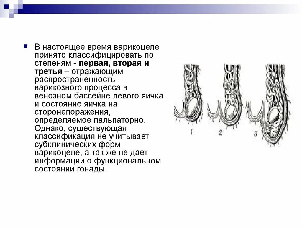 Воспаление семенного канатика у мужчин. Варикозное расширение вен семенного канатика III степени. Варикозное расширение вен семенного канатика II степени. Варикоцеле расширение 3мм. Варикоз яичка 3 степени слева.