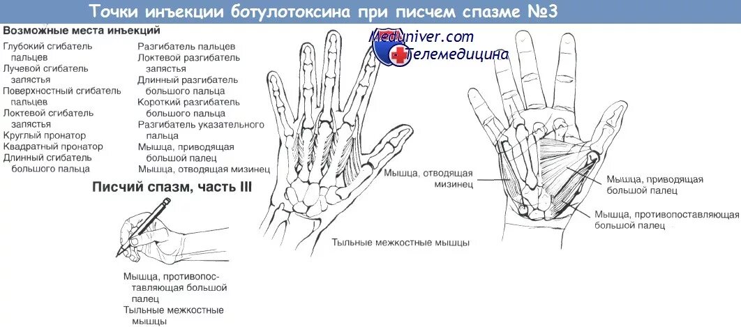 Массаж при писчем спазме. Писчий спазм упражнения. Мышца отводящая мизинец. Точка уколова