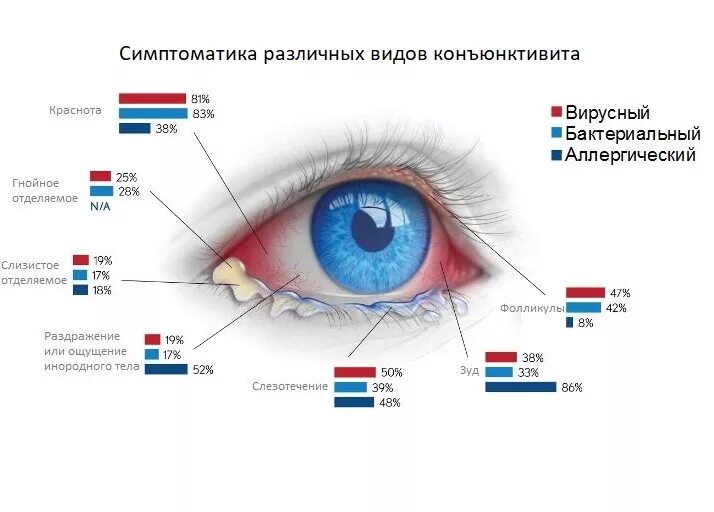 Конъюнктивит хронический схема. Конъюнктивит патогенез схема. Коньюктивит вирусный конъюнктивит и бактериальный конъюнктивит. Аллергический конъюнктивит или кератоконъюнктивит.