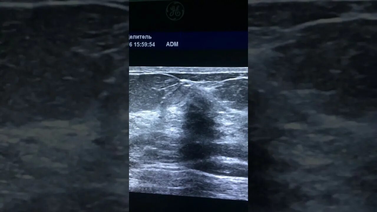 узловая форма фиброзно-кистозной мастопатии. узловая фиброзно кистозная мастопатия. узловая фиброзно кистозная мастопатия. узловая форма фиброзно-кистозной мастопатии на узи. диффузная фиброзно-кистозная мастопатия.