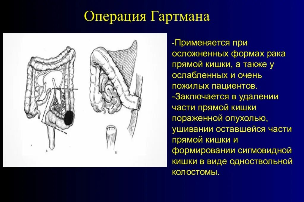 Промежностная аденомэктомия. Биопсия промежностная промежностная. Биопсия промежностная промежностная. Брюшно-промежностная экстирпация прямой кишки по кеню майлсу. Прямая резекция прямой кишки.
