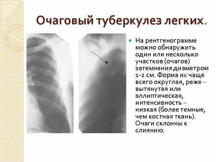 Очаговый туберкулез рентген признаки. Рентгенологические признаки очагового туберкулеза легких. Очаговый туберкулез легких рентген признаки. Рентгенологическая картина очагового туберкулеза.