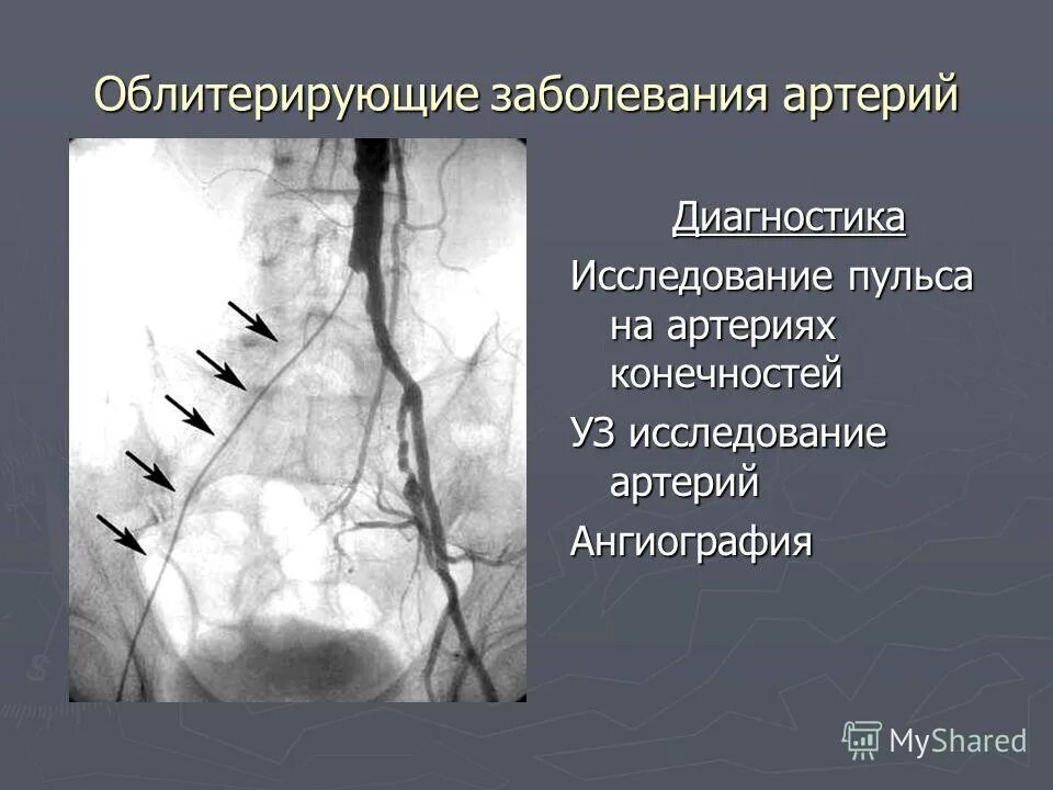 Атеросклероз подвздошных артерий симптомы. Облитерирующий атеросклероз ангиография. Методы диагностики облитерирующего эндартериита.