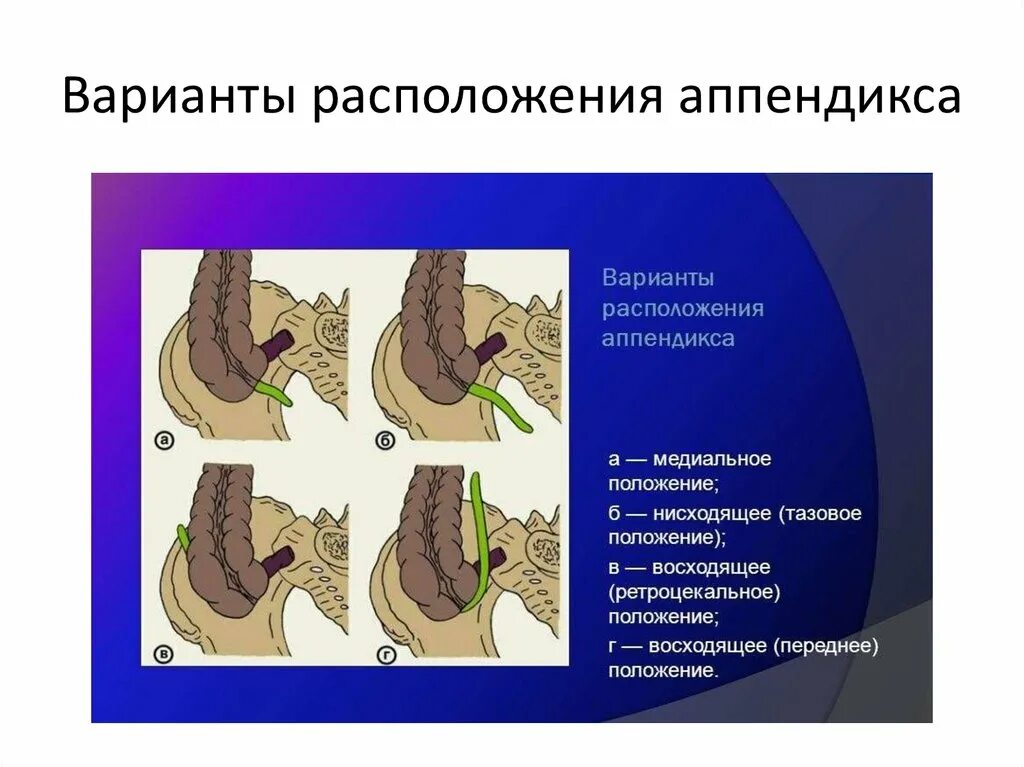 Локализация острого аппендицита. Ретроцекальный аппендицит. Расположение червеобразного отростка. Атипичное расположение аппендикса. Локализация червеобразного отростка.