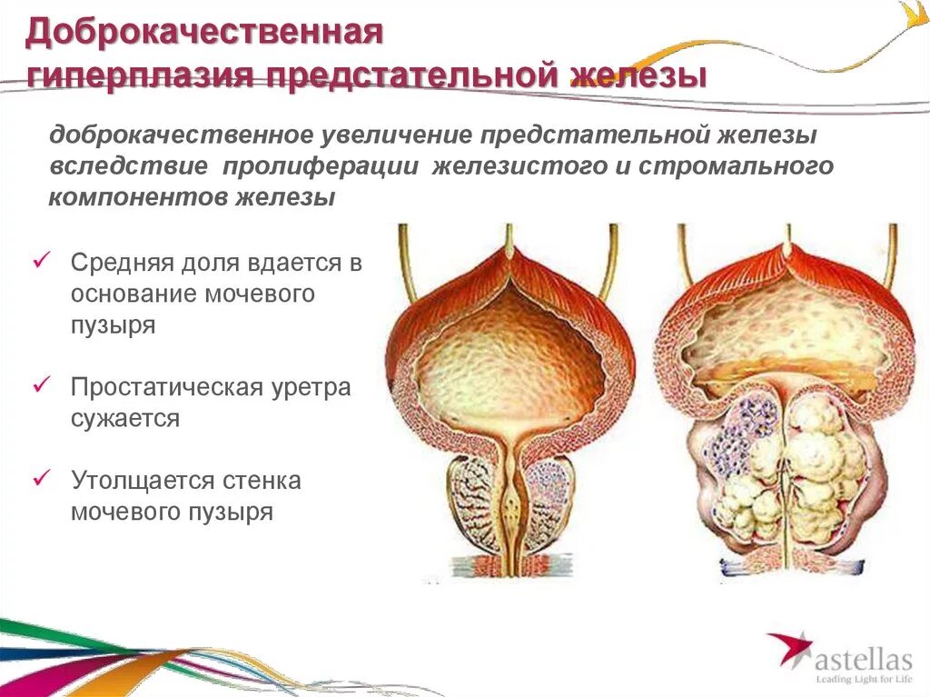 Рост желез. Доли предстательной железы у мужчин. доброкачественная аденома предстательной железы. дгпж предстательной железы что это такое. средняя доля предстательной железы при дгпж.