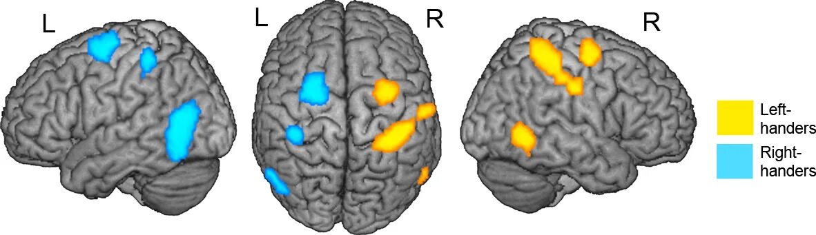 Левая гемисфера мозга. Мозг левши и правши. Левое полушарие мозга. Два полушария мозга. Мозг у леворуких.