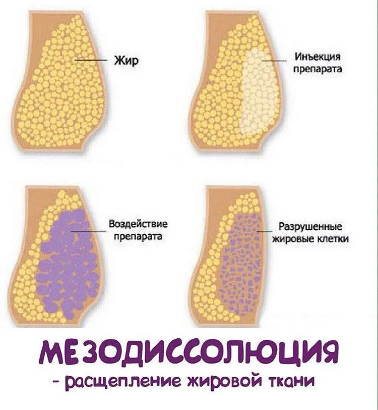 Мезодиссолюция
