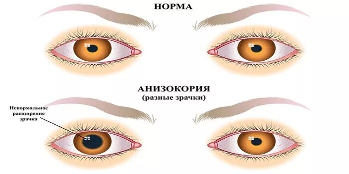 Разного размера зрачки у человека. Разные зрачки причины. Антидепрессанты глаза