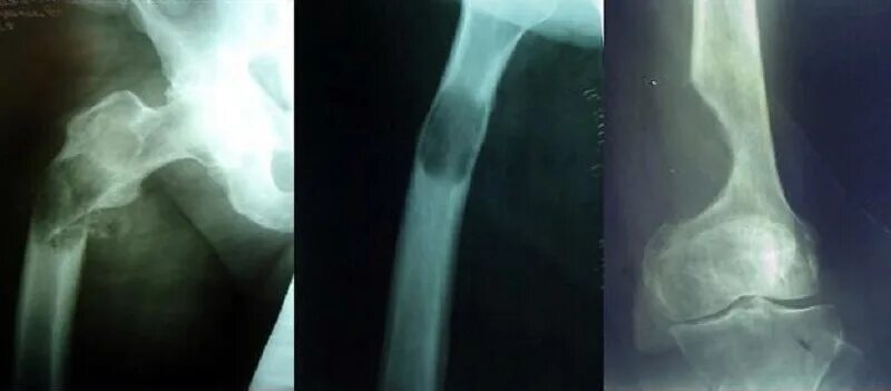 Вторичное поражение костей. Метастазы плечевой кости рентген. Остеолитические метастазы. Метастазы трубчатых костей. Метастатическое поражение кости.