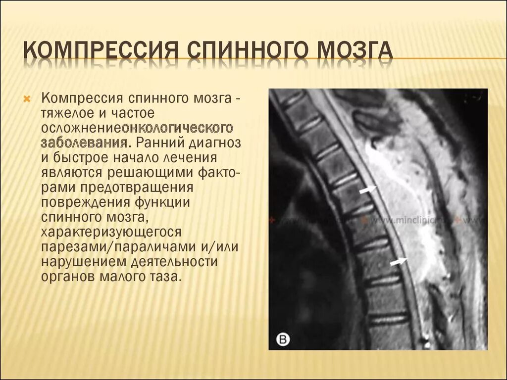 Сдавление спинного. Сдавление спинного мозга. Компрессия спинного мозга. Компрессия спинного мозга симптомы. Компрессия спинномозгового канала.