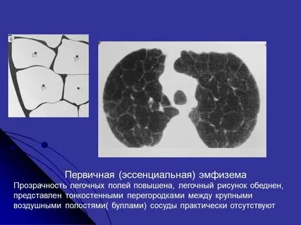 Первичная эмфизема