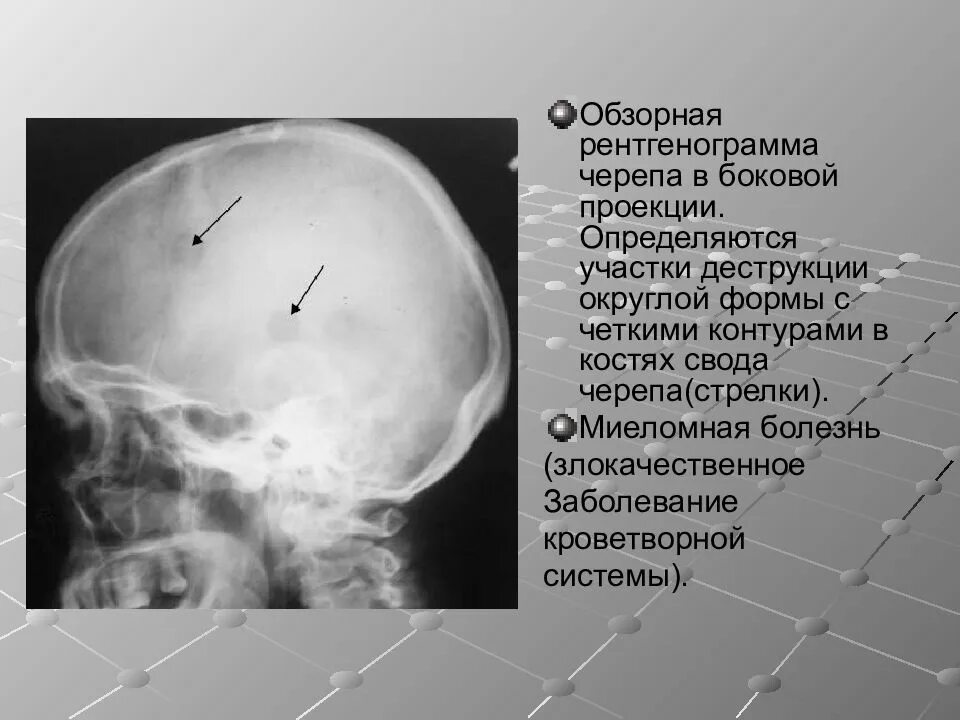 Проекции рентгенограмм черепа. Рентген черепа в боковой проекции норма. обзорная рентгенограмма черепа в боковой проекции. рентгенограмма костей черепа в боковой проекции. рентгенограмма черепа с миеломной болезнью.