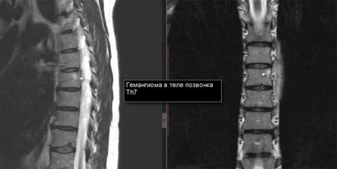 Гемангиома позвонка как лечить