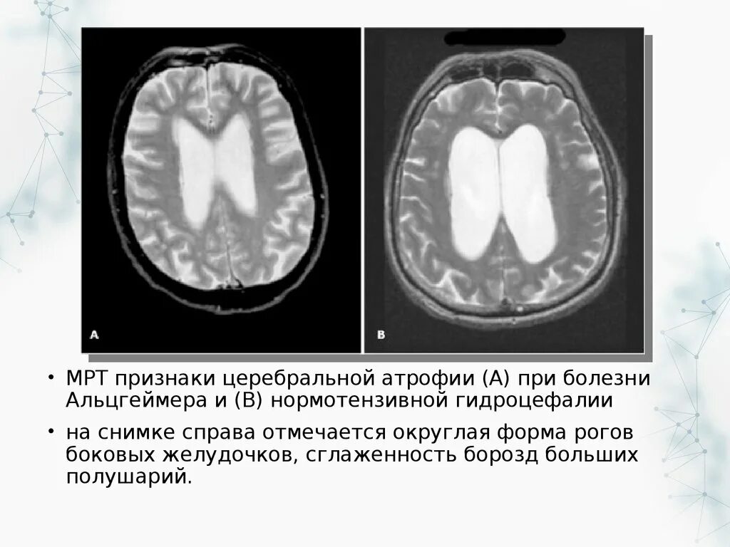 Нормотензивная гидроцефалия кт. Наружная внутренняя гидроцефалия мрт. Нормотензивная гидроцефалия мрт. Заместительная наружная гидроцефалия кт.