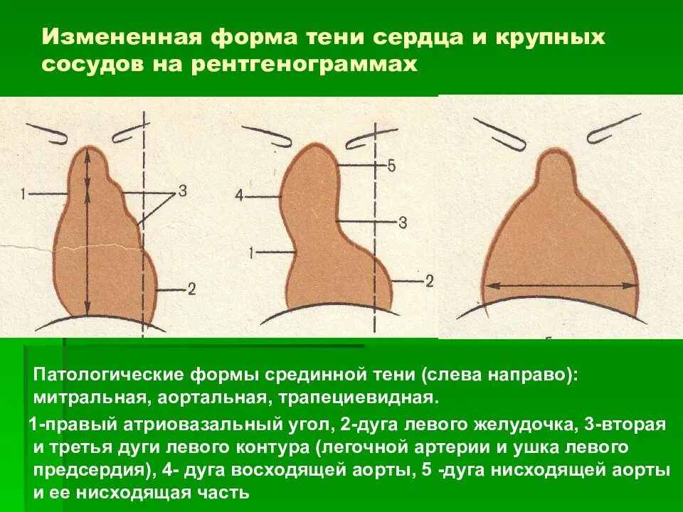 Норма форма сердца. Изменение формы сердца. Формы сердца на рентгенограмме. Тени в форме сердца. Изменение формы сердечной тени.