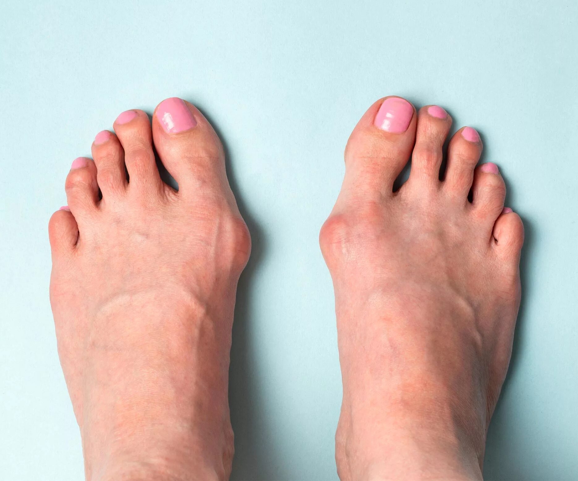 Деформация стопы. Деформация hallux valgus вальгусная. hallux valgus (косточки на стопе).