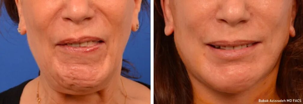 Blog Facial Paralysis Institute