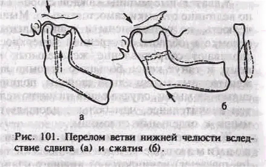 Коррекция альвеолярного отростка верхней и нижней челюсти - виды дефектов альвео