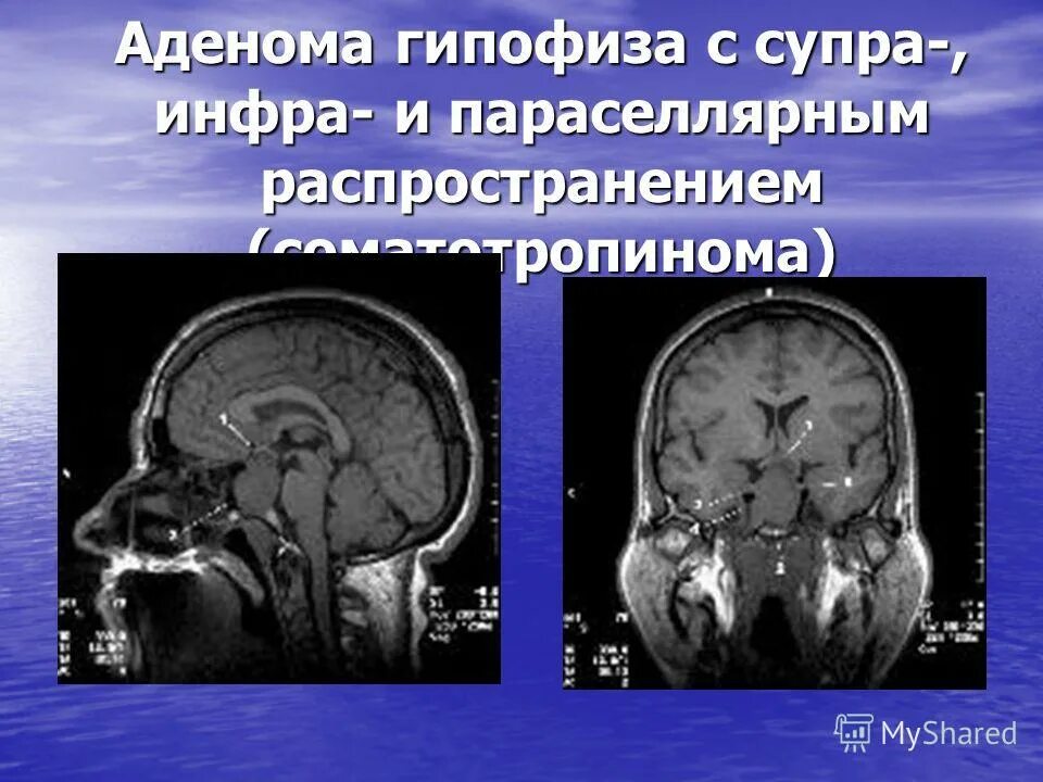 Изменения гипофизе. Супраселлярный рост аденомы гипофиза. Инфраселлярный рост аденомы гипофиза. Супраселлярная аденома гипофиза мрт. Кистозная аденома гипофиза мрт.