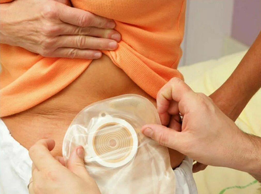 илеостома калоприемник. стомированные пациенты. стомированные пациенты. стомированные пациенты. колостома калоприемник.