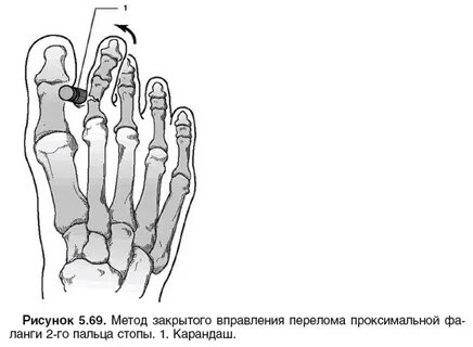 Перелом проксимальной фаланги