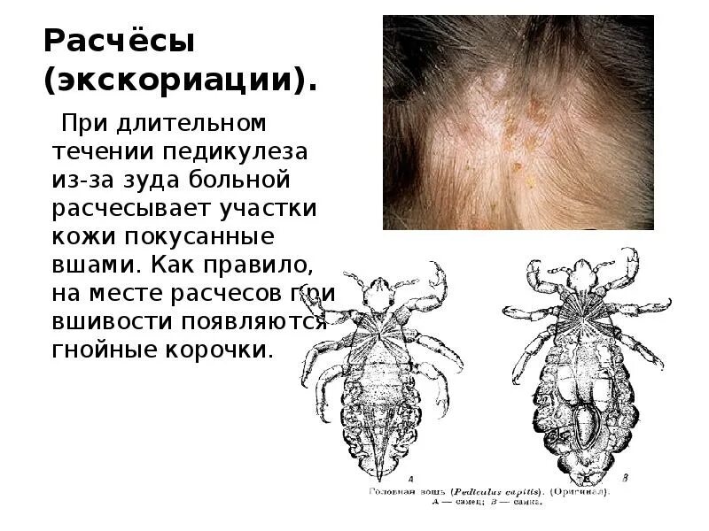 Вши какое заболевание. Головная вошь заболевание. Педикулез презентация.