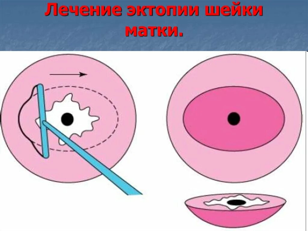 Конизация гистология. Петлевая эксцизия шейки. Петлевая электроконизация шейки матки. Деструкция эксцизия конизация. Электроволновая конизация шейки.