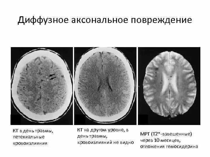 Диффузное аксональное повреждение ДАП головного мозга. Диффузно аксональные повреждения головного мозга кт. Аксональное повреждение головного мозга мрт. Диффузное аксональное повреждение головного мозга ЧМТ.