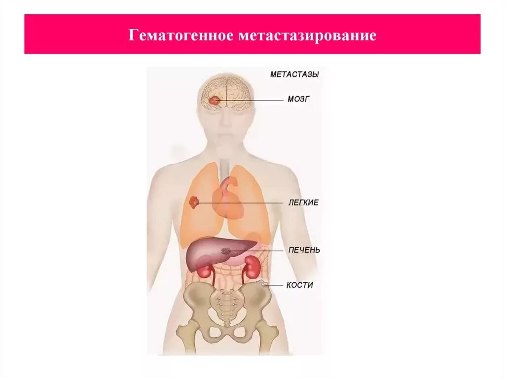 Гематогенное метастазирование. Гематогенный путь метастазирования. Гематогкнные метастазы раза молочнфй железы. Лимфогенное и гематогенное метастазирование.