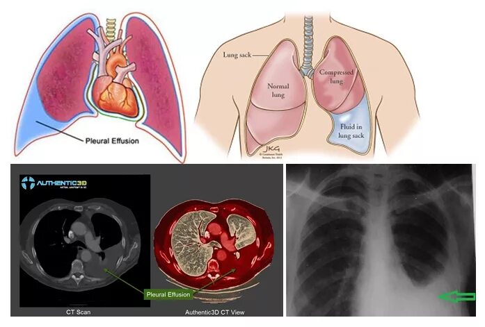 Экссудативный плеврит пункция. Пневмония жидкость в легких. Вода в легких у человека