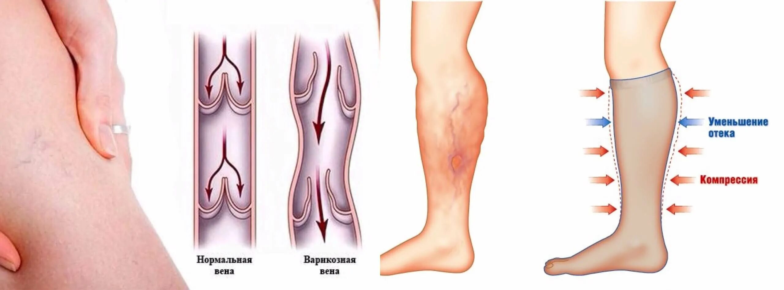 Отек ног после компрессионных чулок. Приспособление для одевания компрессионных чулков. Компрессионная система circaid. Гольфы компрессионные на молнии zip sox. Компрессионные чулки тромбоз.