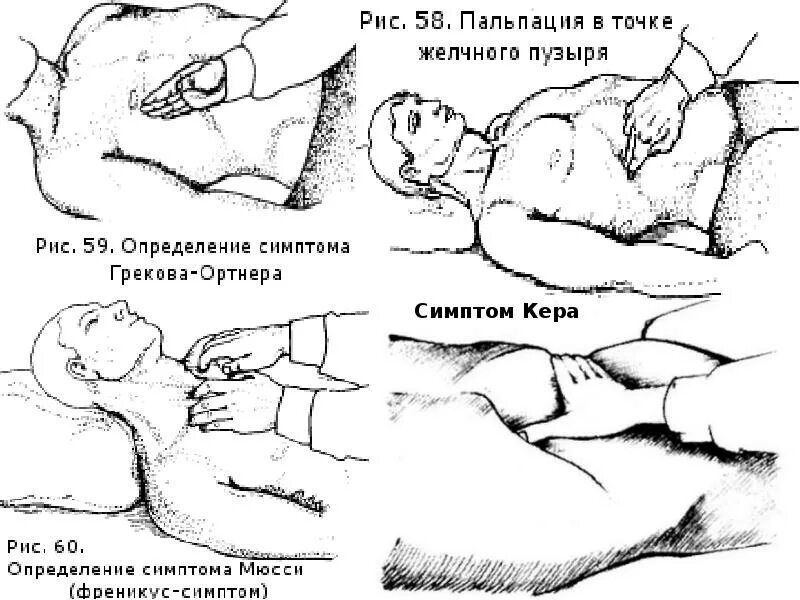 Симптомы ортнера кера мерфи. Симптомы ортнера мерфи мюсси. симптом ортнера кера мюсси мерфи. симптомы пальпации желчного пузыря. симптомы кера мерфи ортнера.