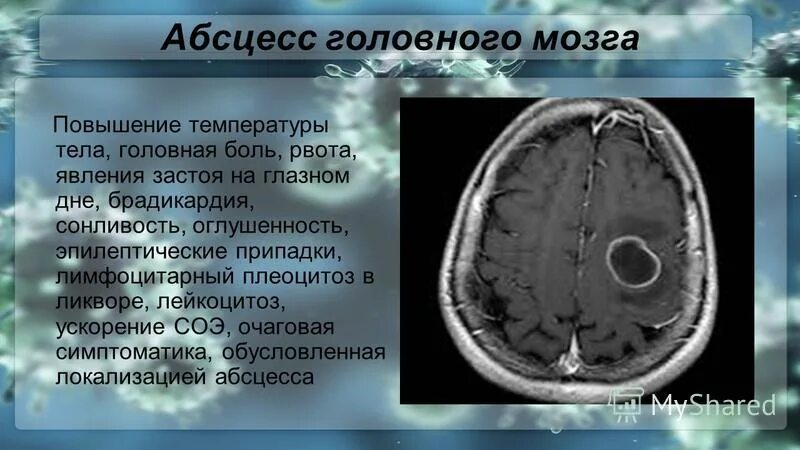 Абсцесс мозга. Эпидуральный абсцесс головного мозга. Абсцесс головного мозга симптомы. Стадии формирования абсцесса мозга. Этапы формирования абсцесса головного мозга.