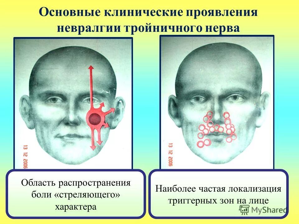 Невралгия тройничного нерва клинические проявления. Клинические симптомы невралгии тройничного нерва. Невралгия тройничного нерва курковые зоны. Невралгия тройничного нерва клиника.