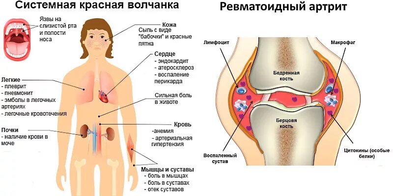 Системная красная волчанка симптомы. СКВ системная красная волчанка симптомы. Системная красная волчанка клиника. Системная красная волчанка артрит. Красная волчанка ревматоидный артрит