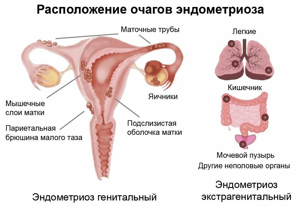 Эндометриоз проявления. Эндометриоз фаллопиевых труб. Эндометриоз в трубе матки. Эндометриоз маточной трубы УЗИ.
