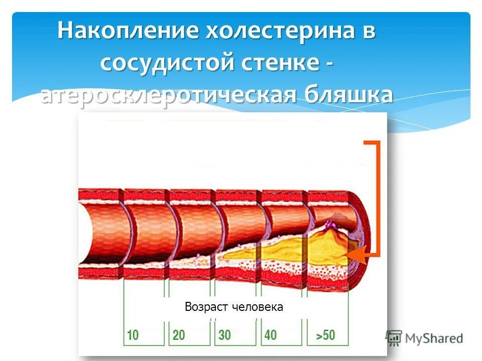 Атеросклероз венечных артерий стадии и степень. Атеросклероз сосудов возраст. Атеросклероз артерии просвет сосуда. Атеросклеротические изменения сосудов. Атеросклероз сосудов ишемическая болезнь.