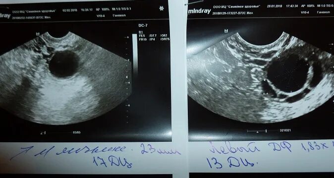 УЗИ яичников после овуляции. Стимуляция овуляции УЗИ. Болят яичники стимуляция