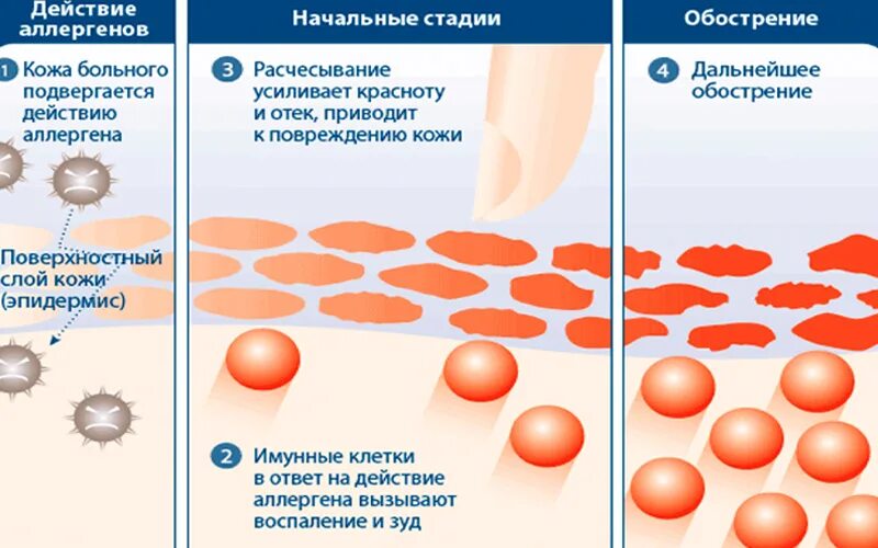 Атопический дерматит везикулы. Аллергический контактный дерматит. Атопический контактный дерматит. Через сколько вода попадает в пузырь