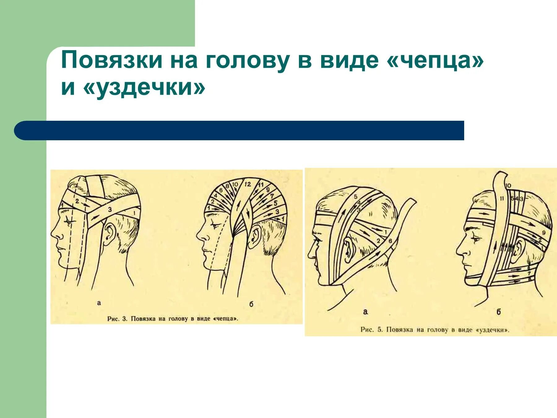 Повязки на голову в виде «Чепца» и «уздечки». Повязка чепец и уздечка. Перевязка головы чепец. Наложение повязки на голову в виде Чепца. Повязка уздечка накладывается