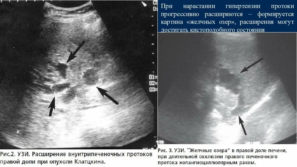 Отекает желчный пузырь. Расширенный проток желчного пузыря. Объемное образование желчного пузыря УЗИ. Холангит желчных протоков на УЗИ. Опухоль протоков желчного пузыря на УЗИ.