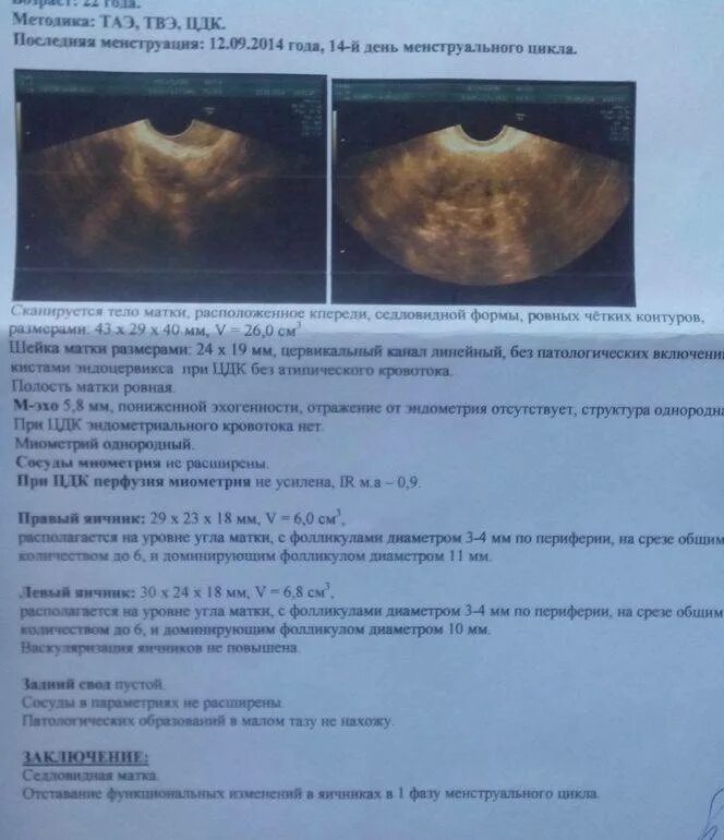 Какие диагнозы матки. УЗИ матки беременность 21 день цикла. УЗИ беременность эндометрий 9 мм. УЗИ полости матки, яичников. Эндометрий по УЗИ 12 день цикла.