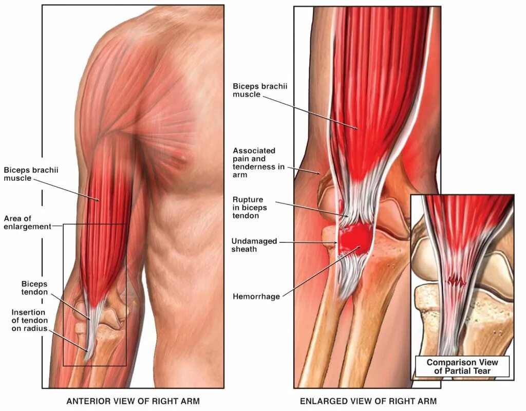 К чему крепится бицепс. Неполный разрыв сухожилия бицепса. Сухожилия головки двуглавой мышцы плеча. Разрыв дистального сухожилия бицепса. Сухожилие двуглавой мышцы плеча анатомия.