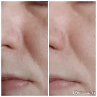 Дарсонваль при гематомах