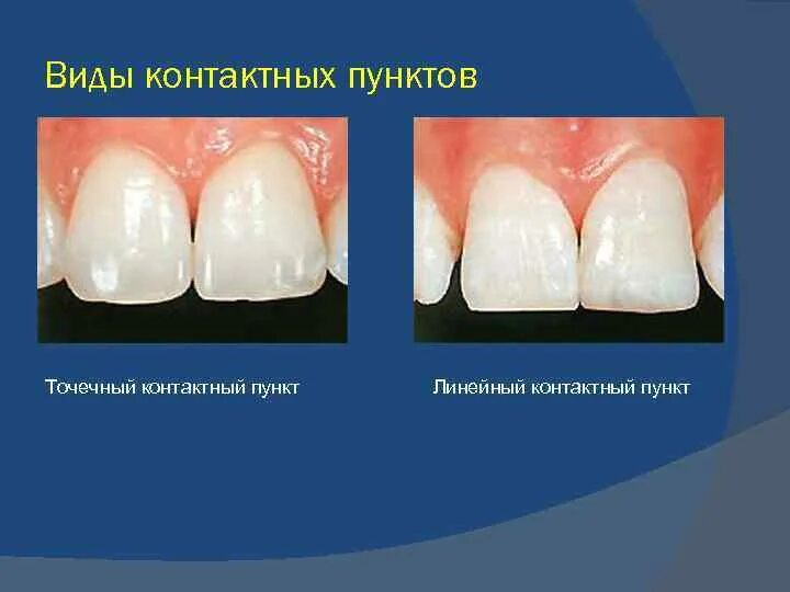 Плотный отсутствие. Восстановление контактного пункта у зубов. Контактные пункты зубов.