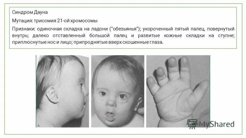 К какой мутации относится синдром дауна. К какой мутации относится синдром дауна