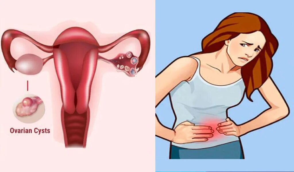Болит правая сторона яичников. Киста вышла с месячными.