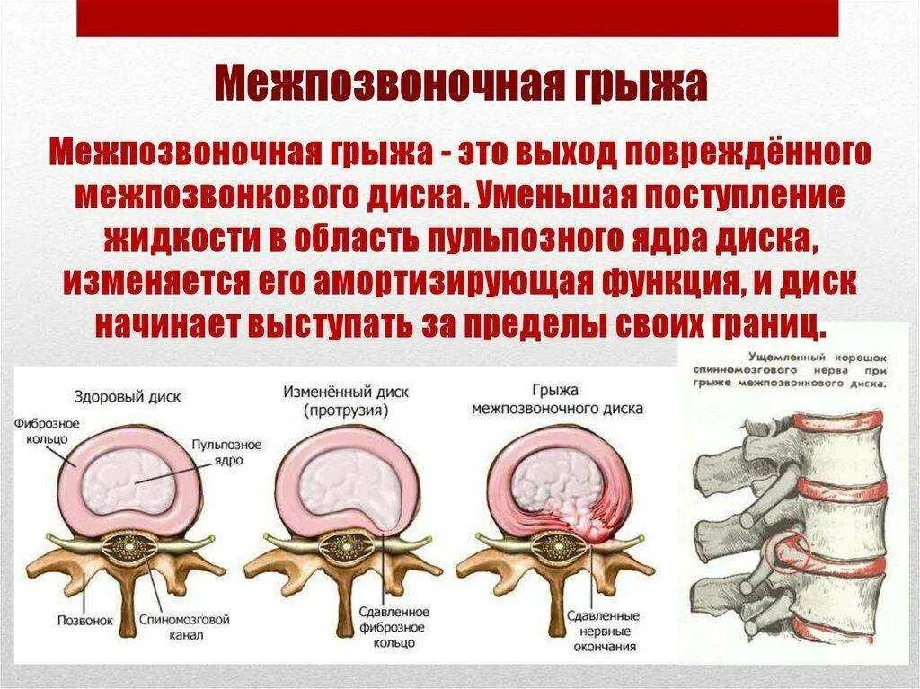 Грыжа межпозвоночного диска симптомы. Протрузия межпозвоночных дисков. Грыжа дисков протрузия дисков. Грыжи позвоночника в поясничном отделе схема. Диффузное выбухание межпозвоночного